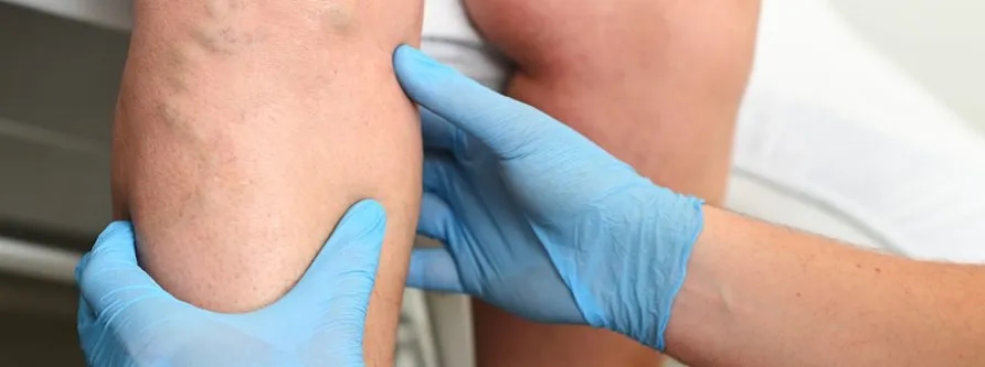 Niewydolność zastawek żylnych - poznaj skuteczne metody leczenia w 2025